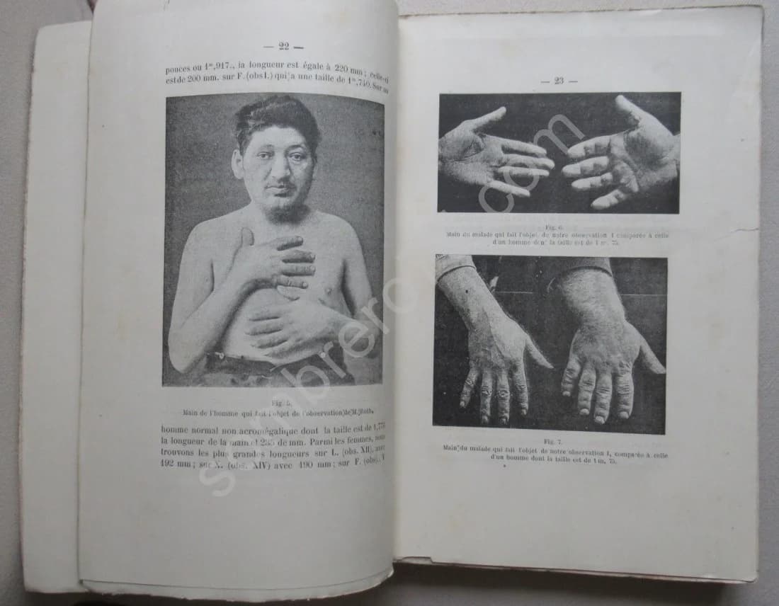 L'Acromégalie Maladie de P Marie - Image 3