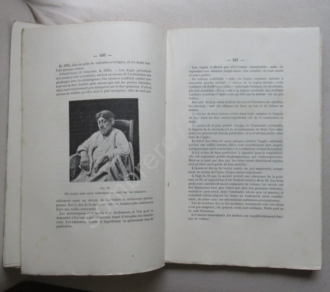 L'Acromégalie Maladie de P Marie - Image 4