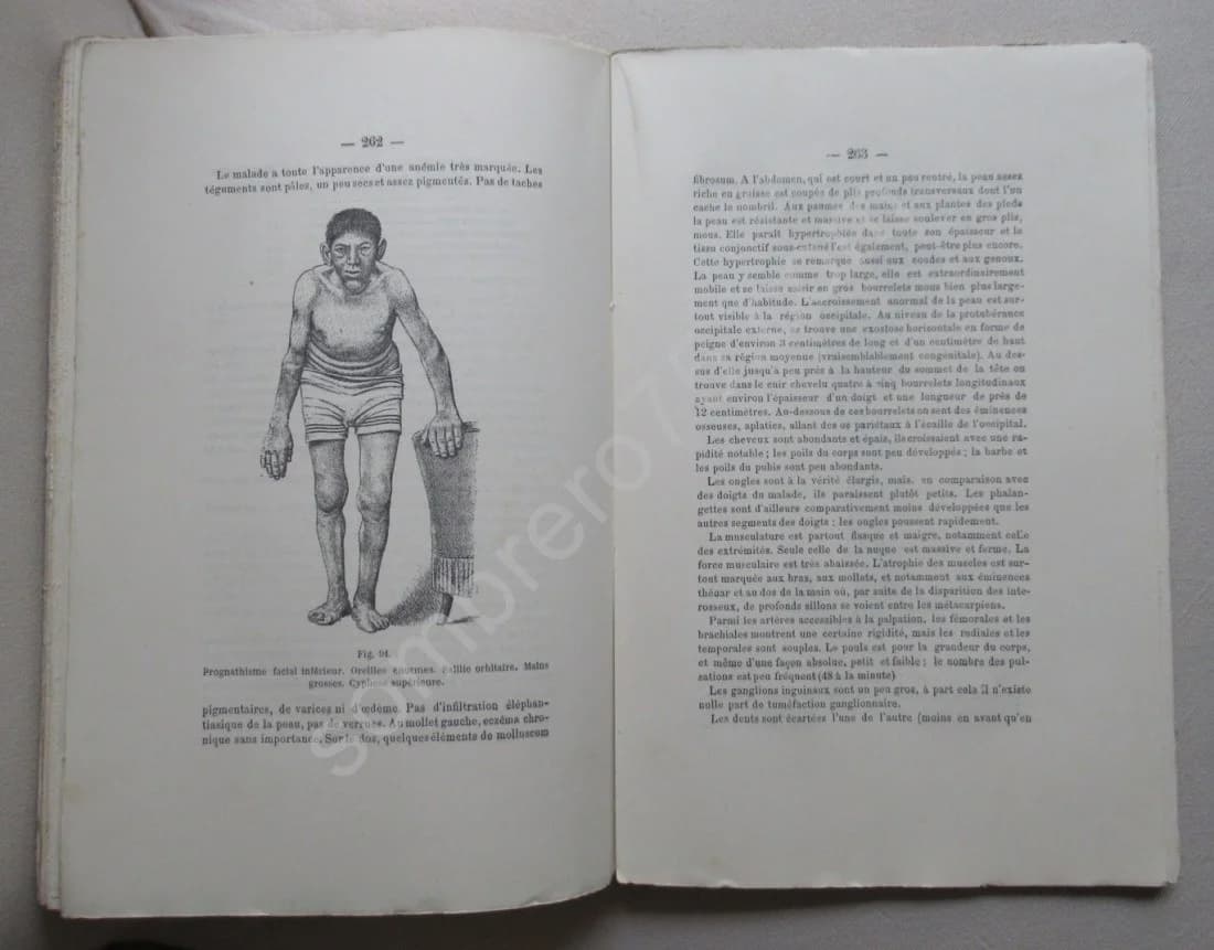 L'Acromégalie Maladie de P Marie - Image 5