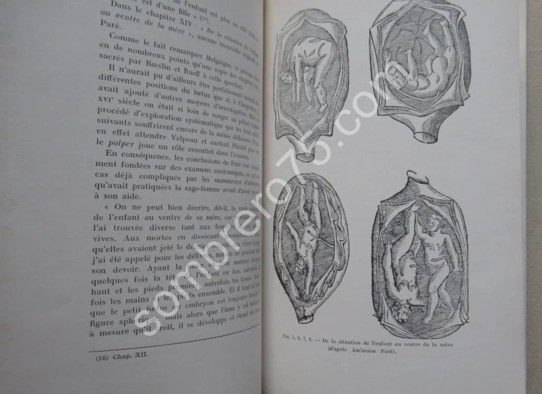 A Propos du Rôle Obstétrical d'Ambroise Paré. Critique de textes - Image 7