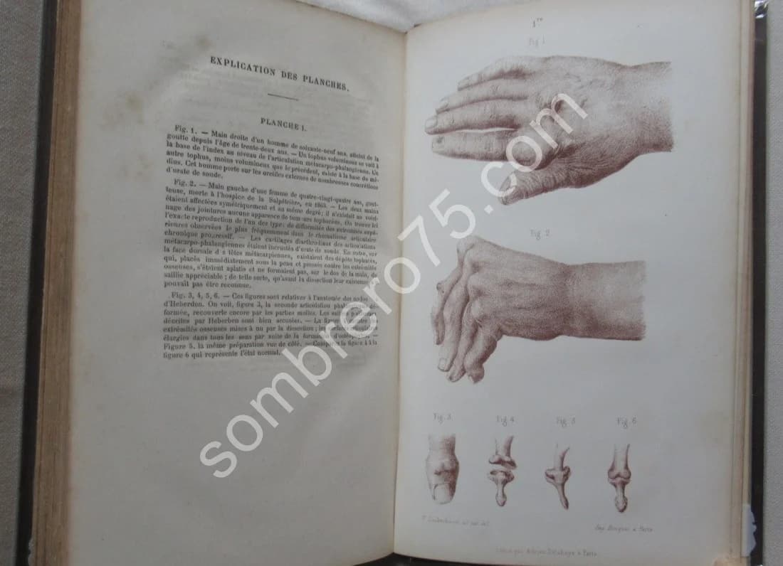 Leçons Cliniques sur les Vieillards et les Maladies Chroniques. J M CHARCOT - Image 6