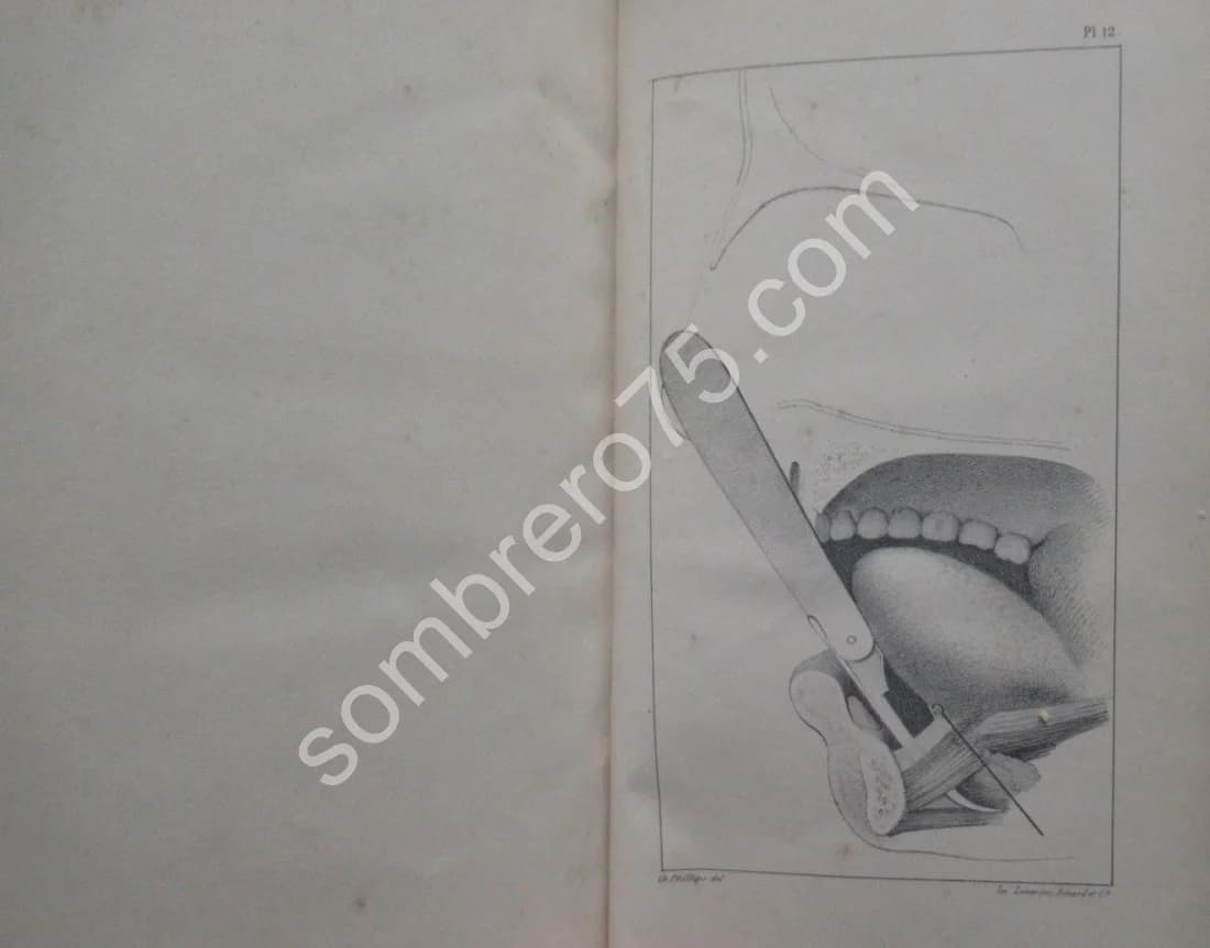 De la Ténotomie sous Cutanée - Dr Phillips. 1841 - Image 4