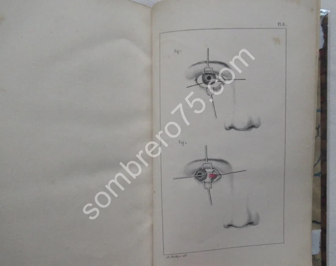 De la Ténotomie sous Cutanée - Dr Phillips. 1841 - Image 7