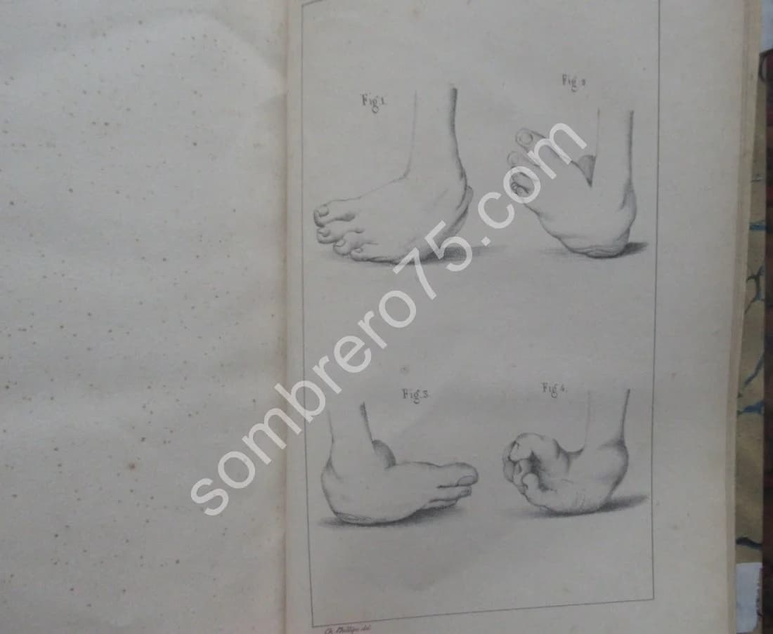De la Ténotomie sous Cutanée - Dr Phillips. 1841 - Image 8